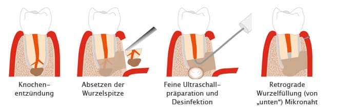 Mikrochirurgie Wurzelkanal