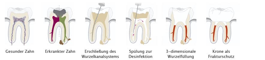 Wurzelkanalbehandlung Lübeck